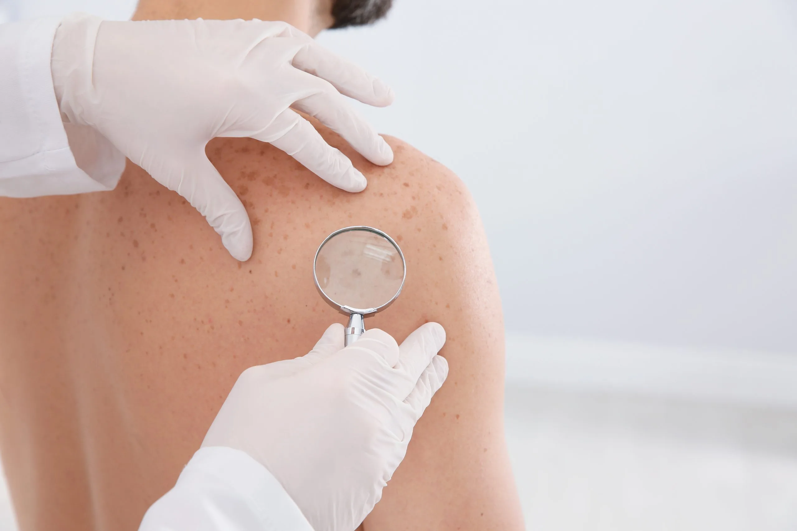 Dermatologist in white gloves examining patient's skin lesion with magnifying glass