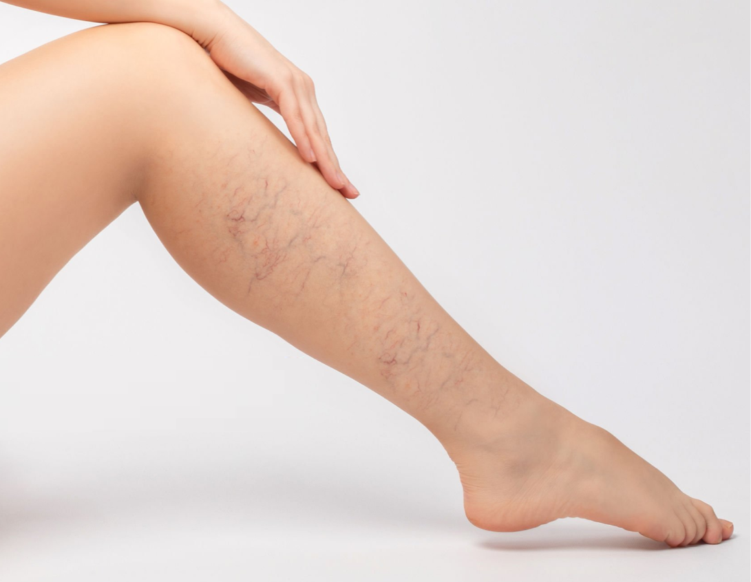 Spider Vein Removal in Phoenix, AZ Banner