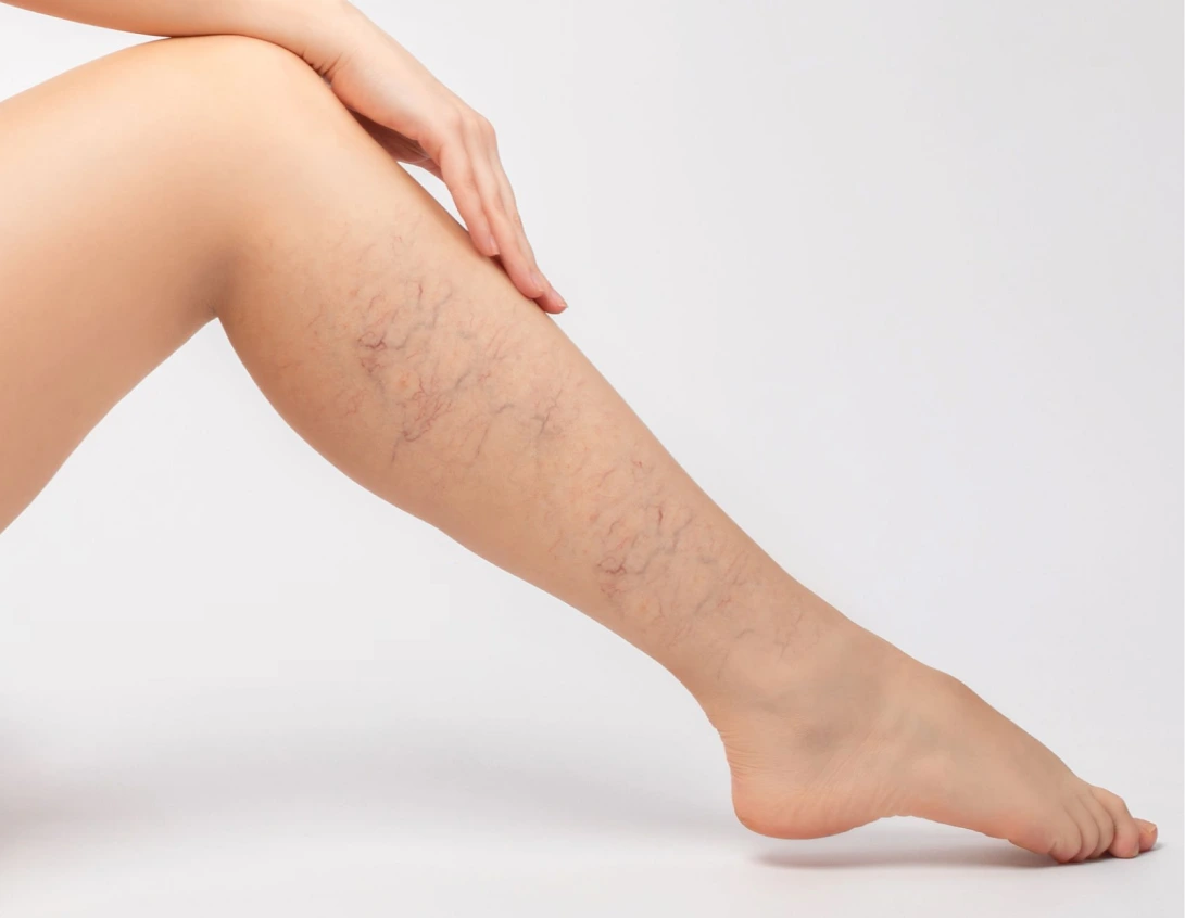 Spider Vein Removal in Phoenix, AZ Banner