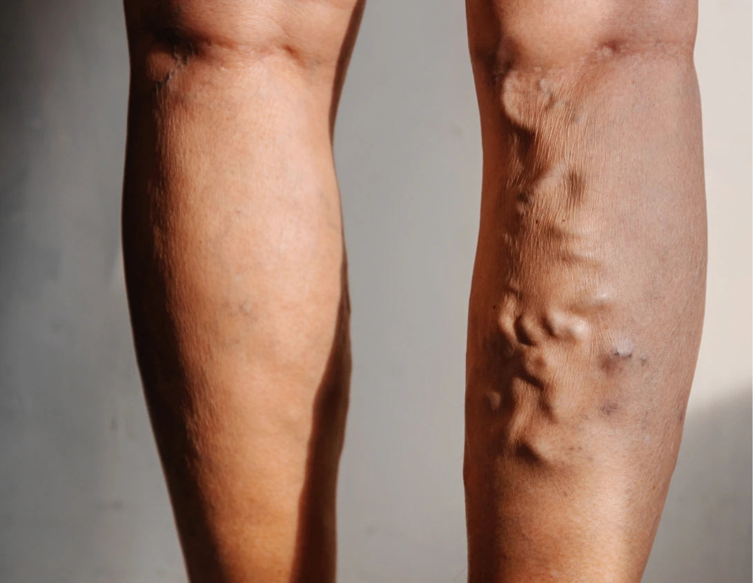 Varicose Vein Treatment in Phoenix, Arizona Banner