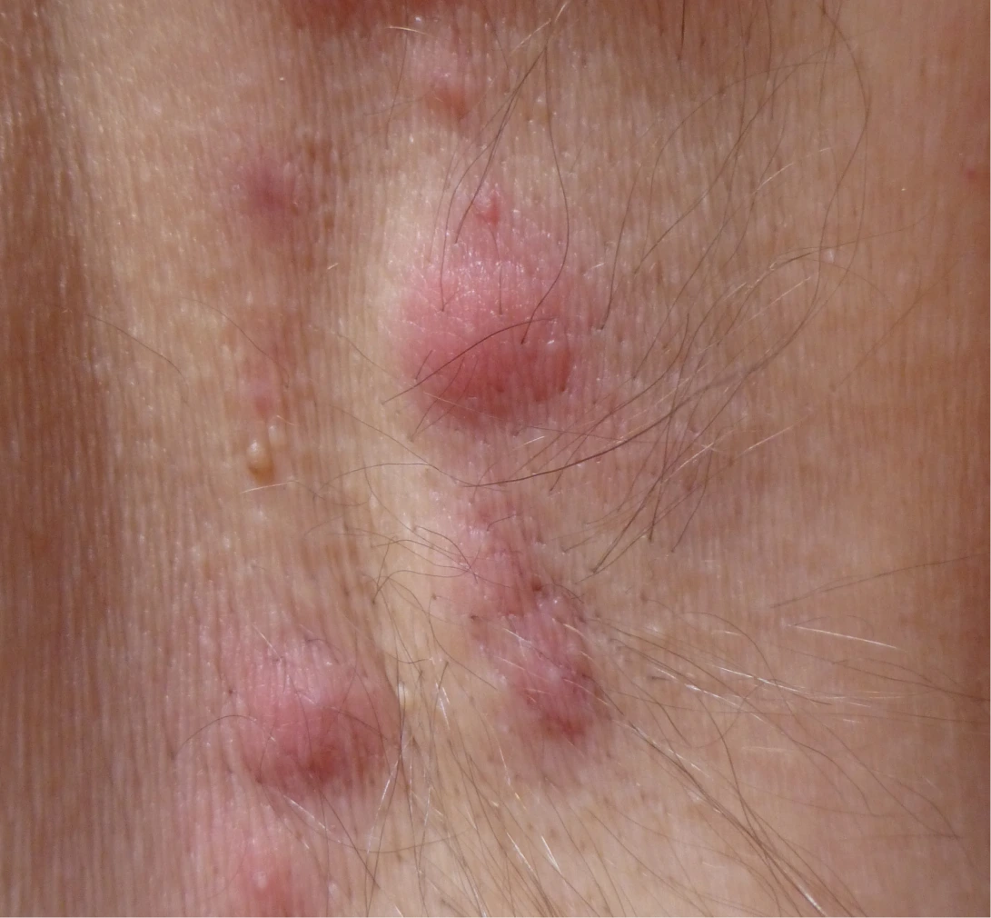 Hidradenitis Suppurativa Surgery in Phoenix, AZ Banner