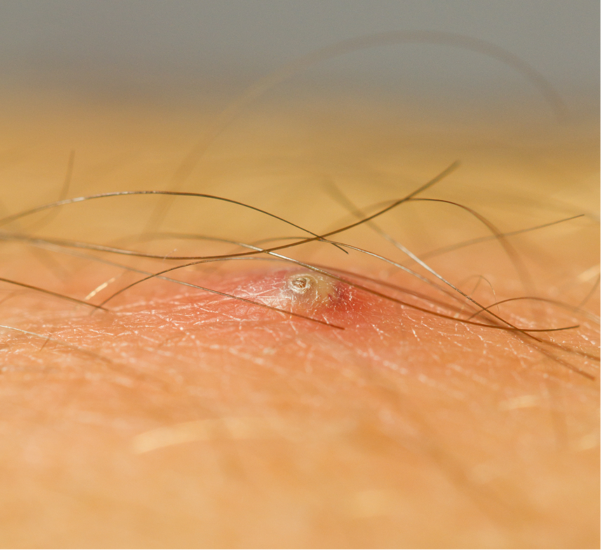 Pilonidal Cyst Surgery in Phoenix, Arizona Banner