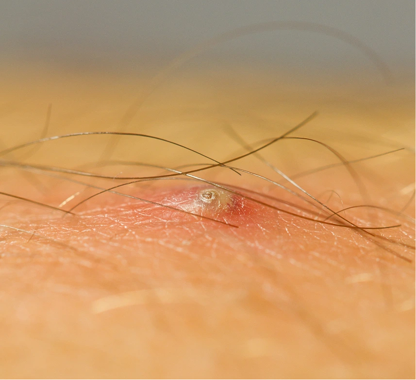 Pilonidal Cyst Surgery in Phoenix, Arizona Banner