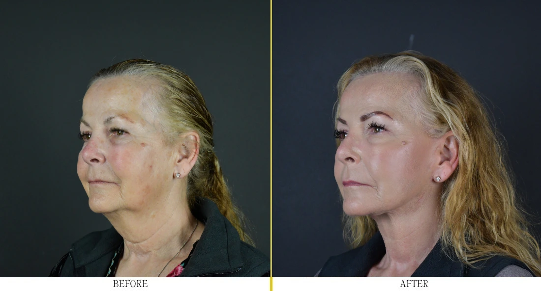 Woman's face, profile view, before and after facial rejuvenation treatment showing improved skin texture and jawline definition