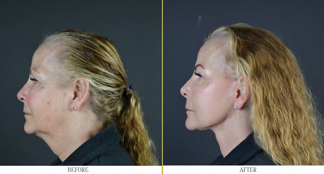 Before and after profile comparison of woman's chin and jawline, labeled before and after