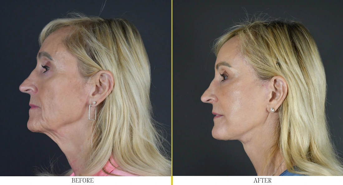 Woman's face, profile view, before and after rhinoplasty showing refined nasal bridge and tip definition