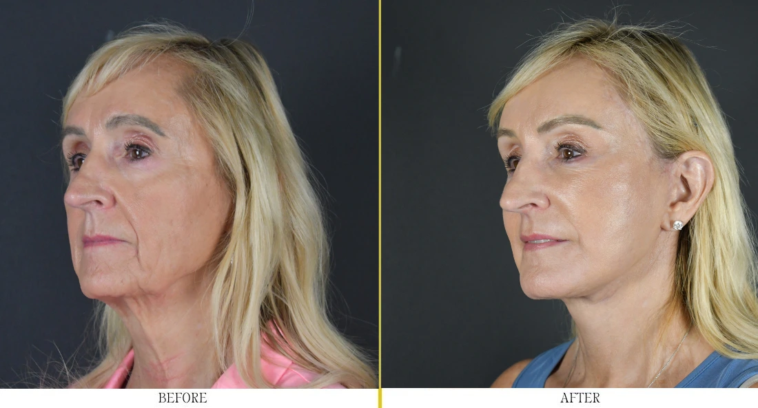 Woman's face, three-quarter view, before and after facial rejuvenation showing reduced wrinkles and improved facial contour