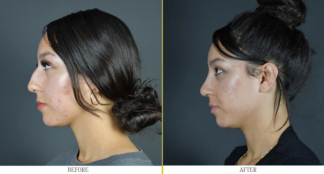 Woman's face, profile view, before and after rhinoplasty showing improved nasal contour and refined tip