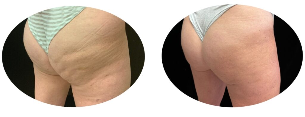 Cellulite Treatment Banner