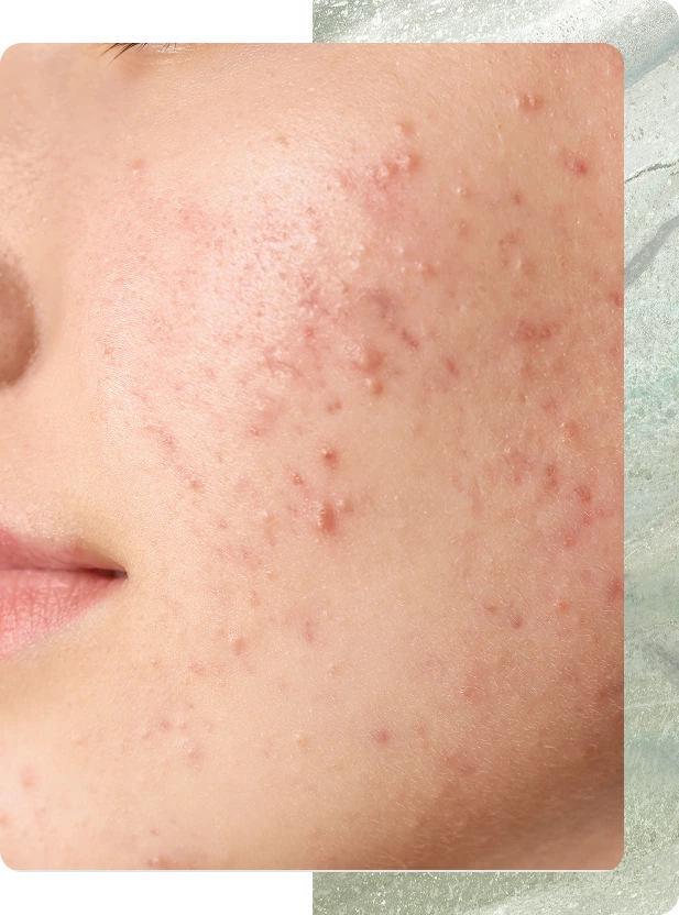 Dermatology Experts South Boston, MA: Acne Treatment & Scarring Banner