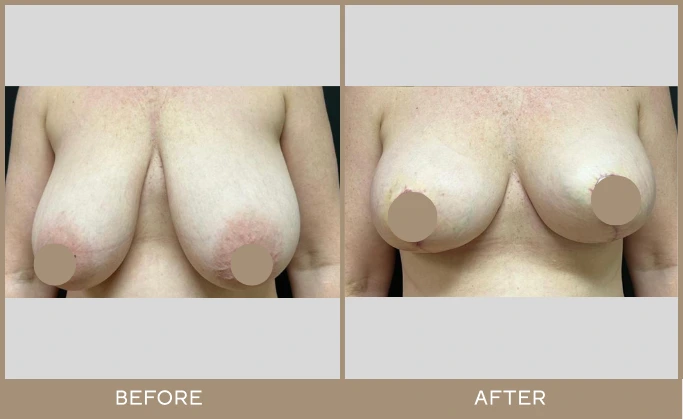 Before and after breast lift showing improved projection and repositioned nipples