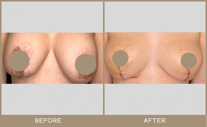 Before and after breast lift with surgical markings visible on before image