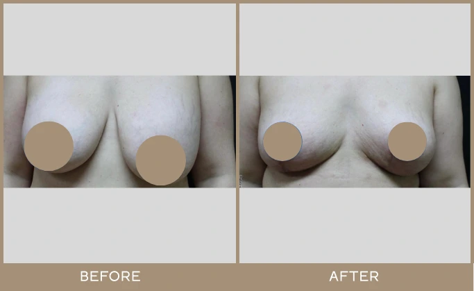 Before and after breast lift demonstrating enhanced shape and elevation