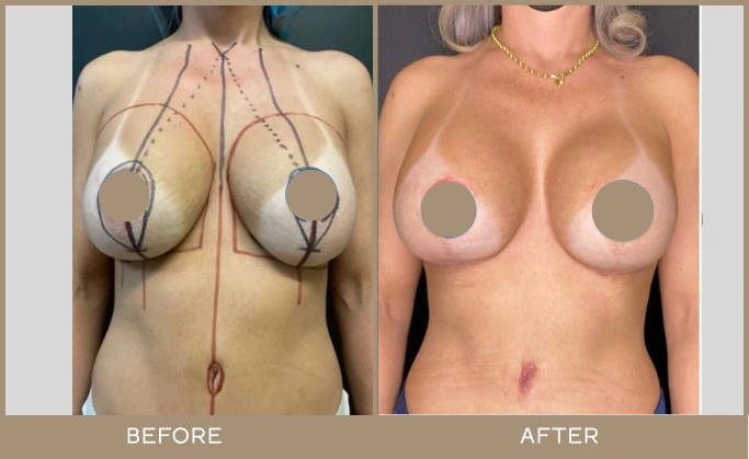 Before and after breast lift with surgical markings and incision lines visible pre-procedure