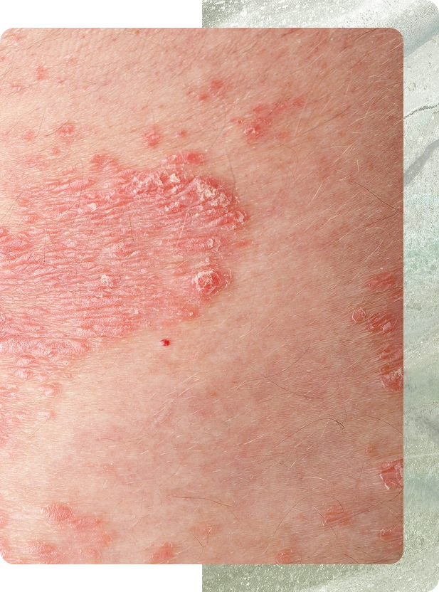 South Boston MA Dermatology Clinic: Eczema Treatment Banner