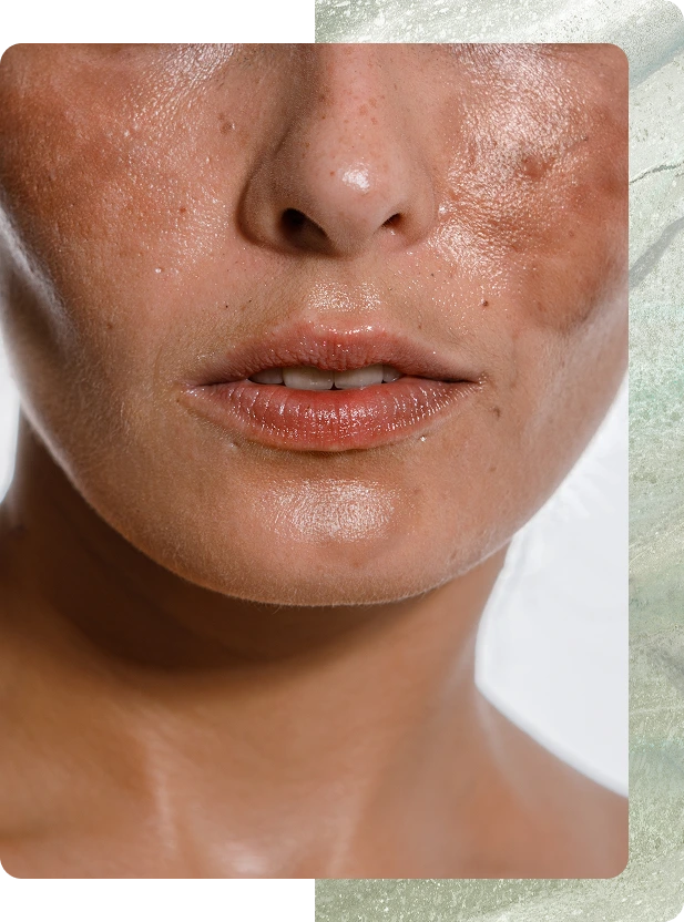 Dermatology South Boston, MA: Hyperpigmentation Treatment Banner