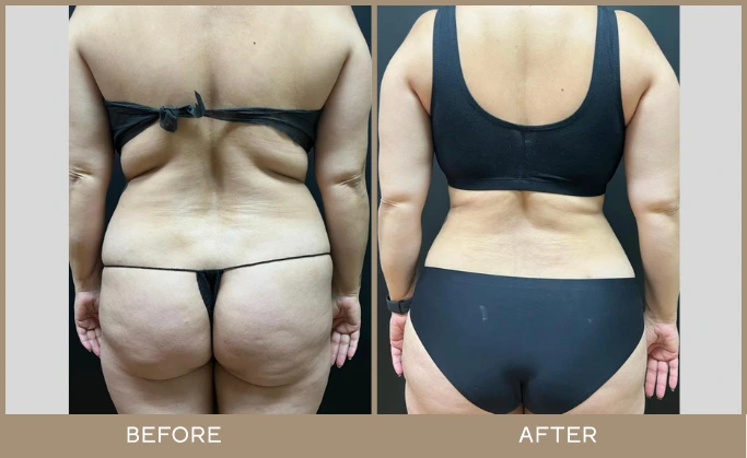 regeneris medspa Lipo 12.1