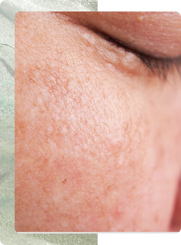 South Boston, MA Dermatology: Melasma Treatment Banner