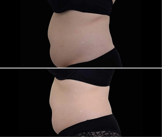EMSCULPT NEO® Before and Afters Gallery