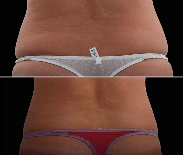 EMSCULPT NEO® Before and Afters Gallery