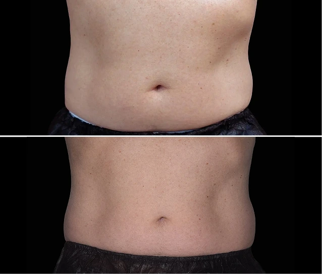 EMSCULPT NEO® Before and Afters Gallery