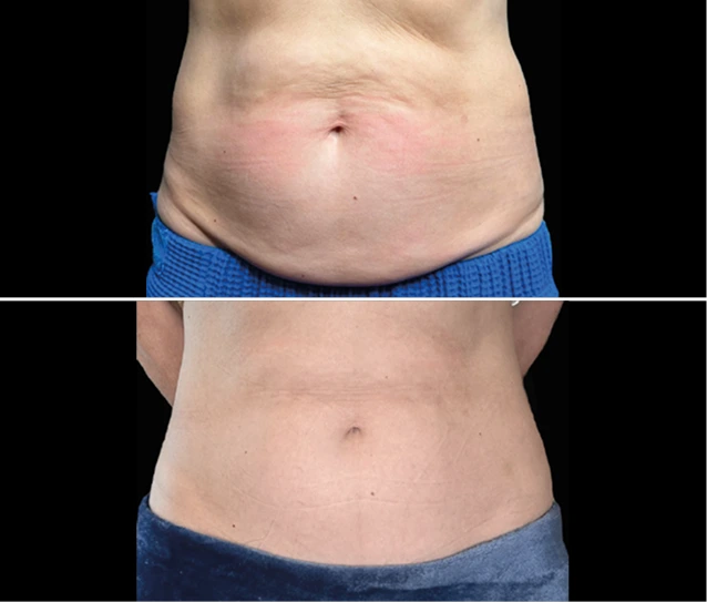 EMSCULPT NEO® Before and Afters Gallery