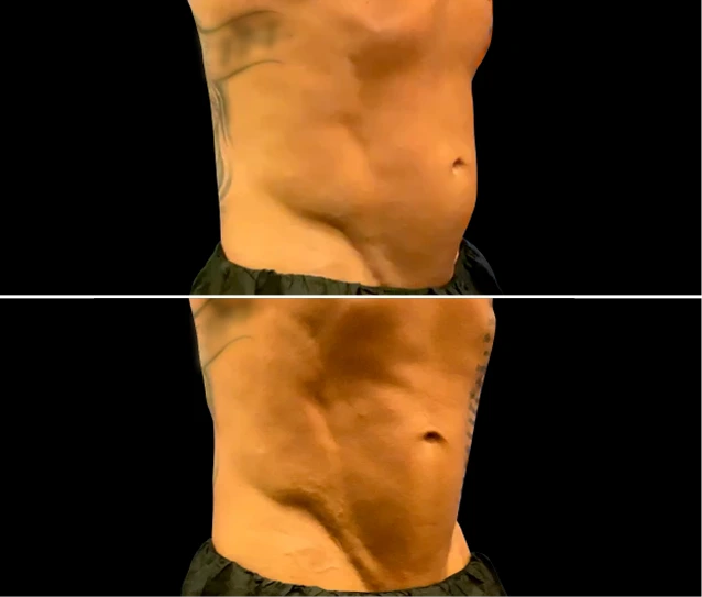 EMSCULPT NEO® Before and Afters Gallery