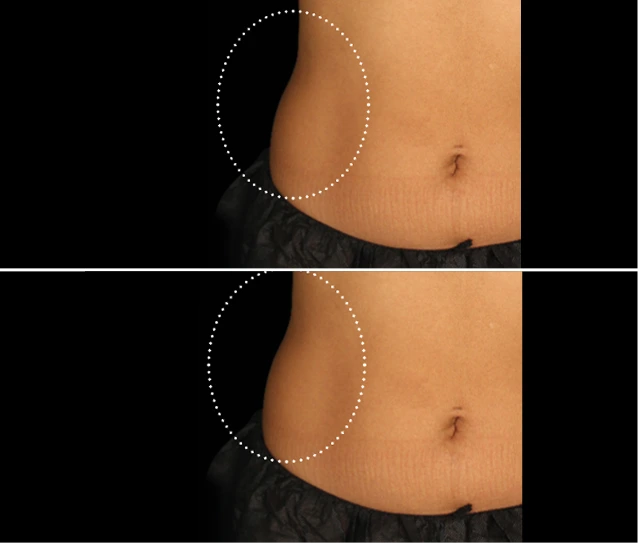 EMSCULPT NEO® Before and Afters Gallery