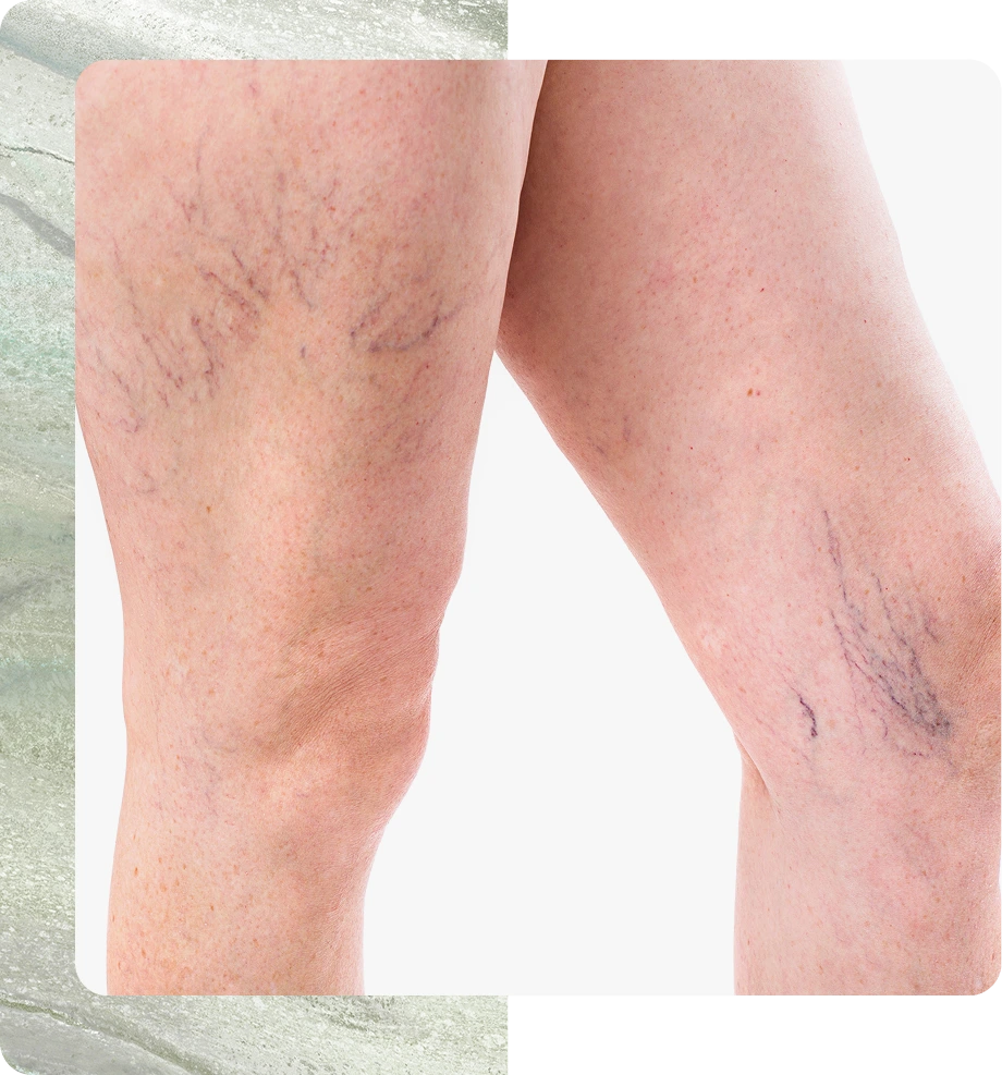 Laser Treatment for Veins Boston, MA Banner