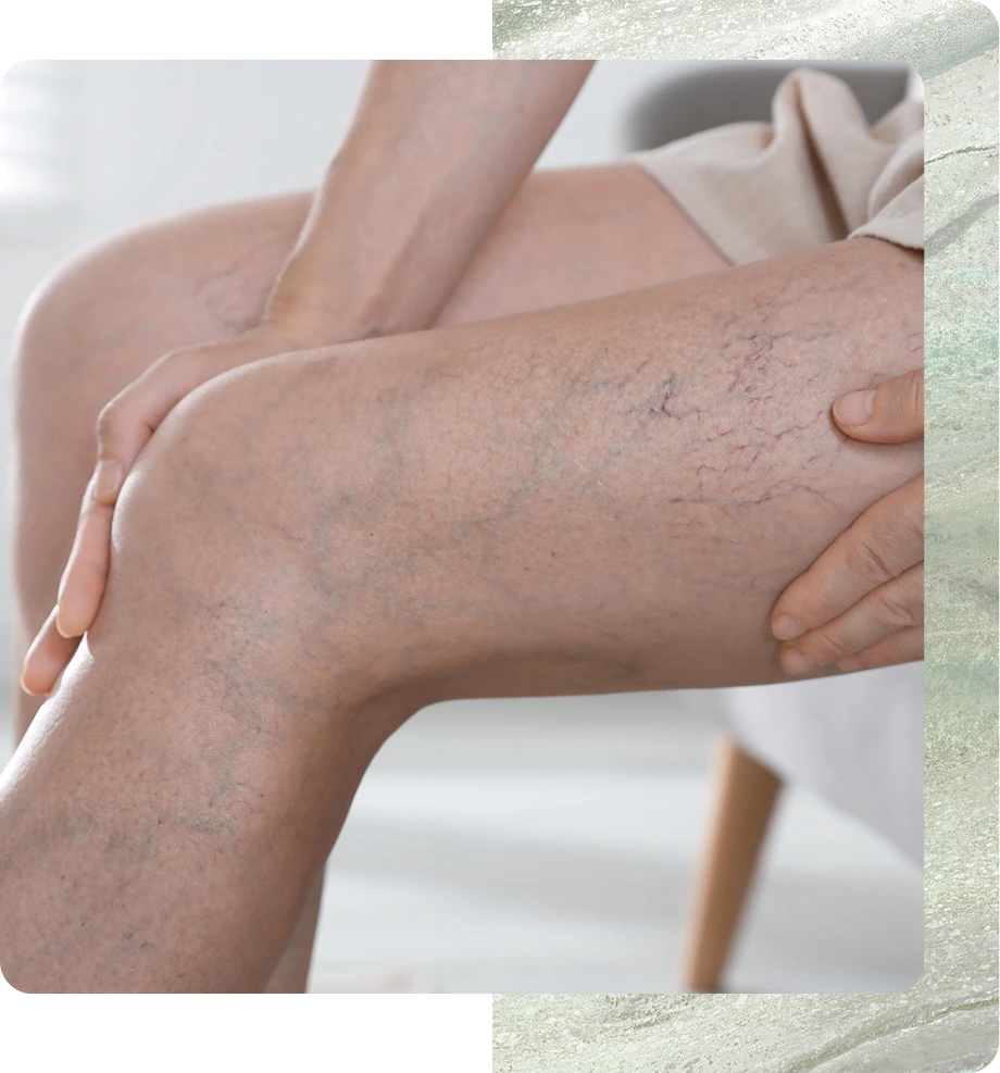 Spider Vein Laser Treatment Boston Banner