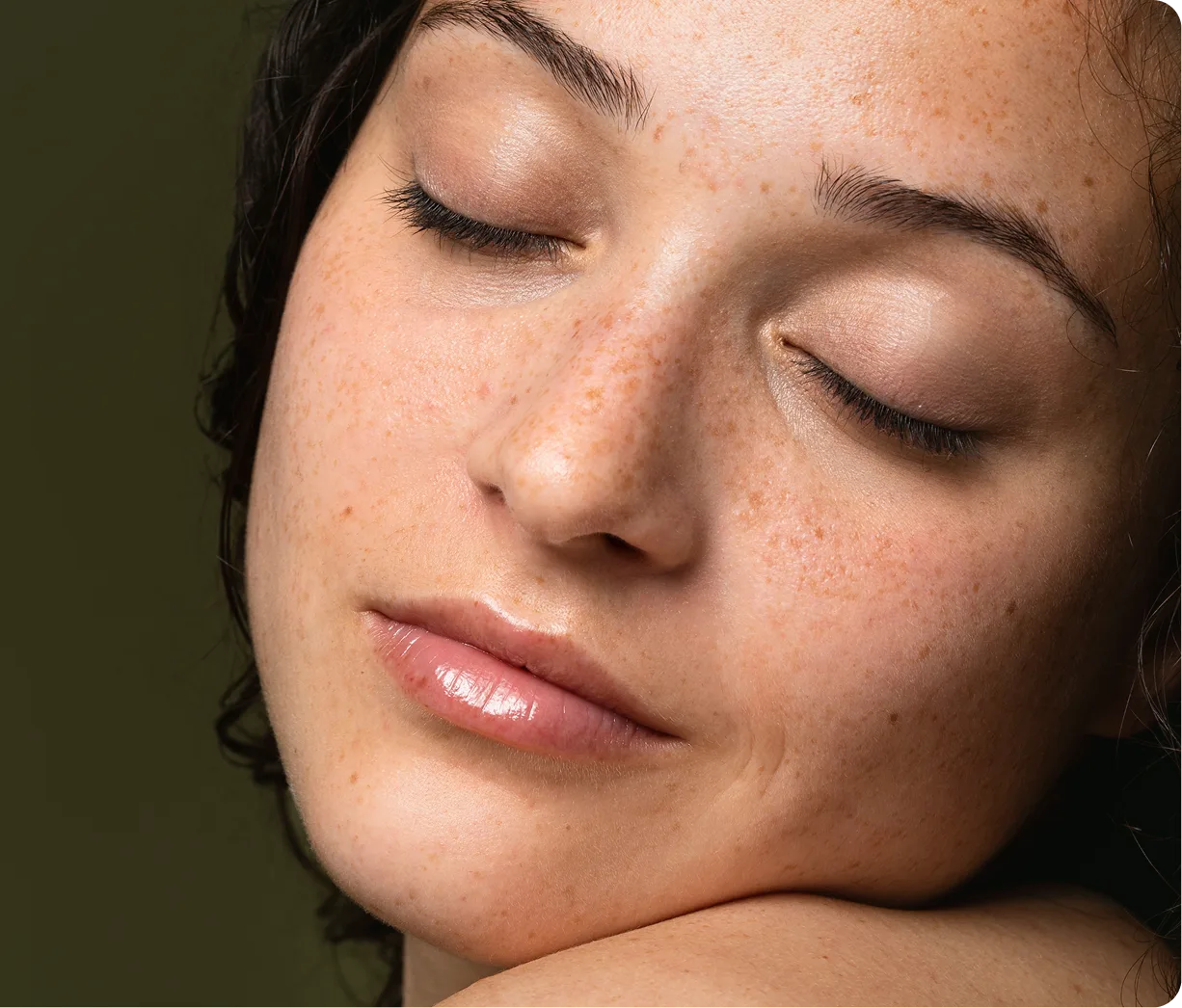 Melasma Treatment Boston, MA Banner