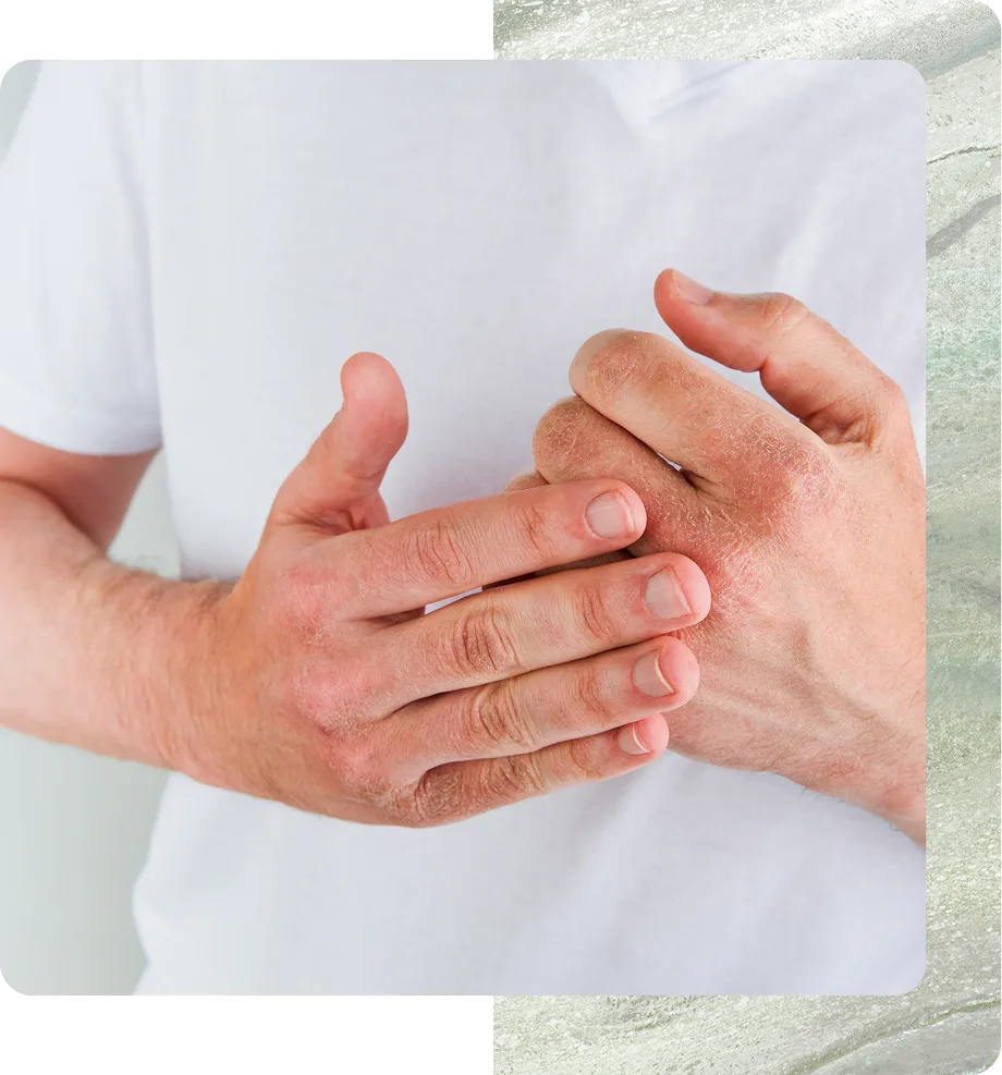 Eczema Specialist in Boston, MA Banner