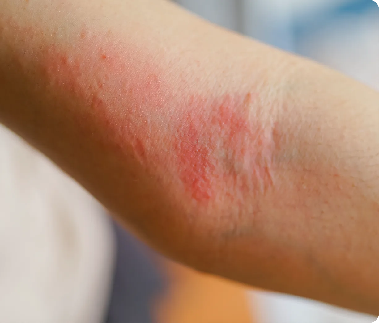 Eczema Treatment Boston MA Banner