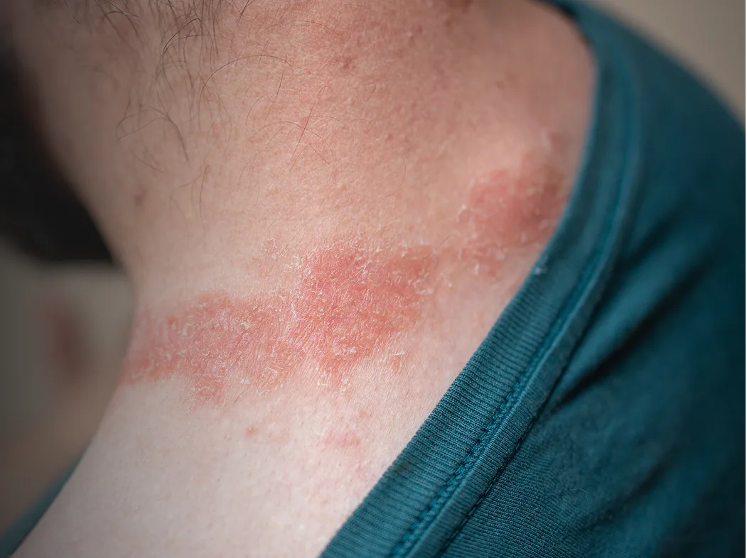 Eczema Treatment in Boston, MA Banner