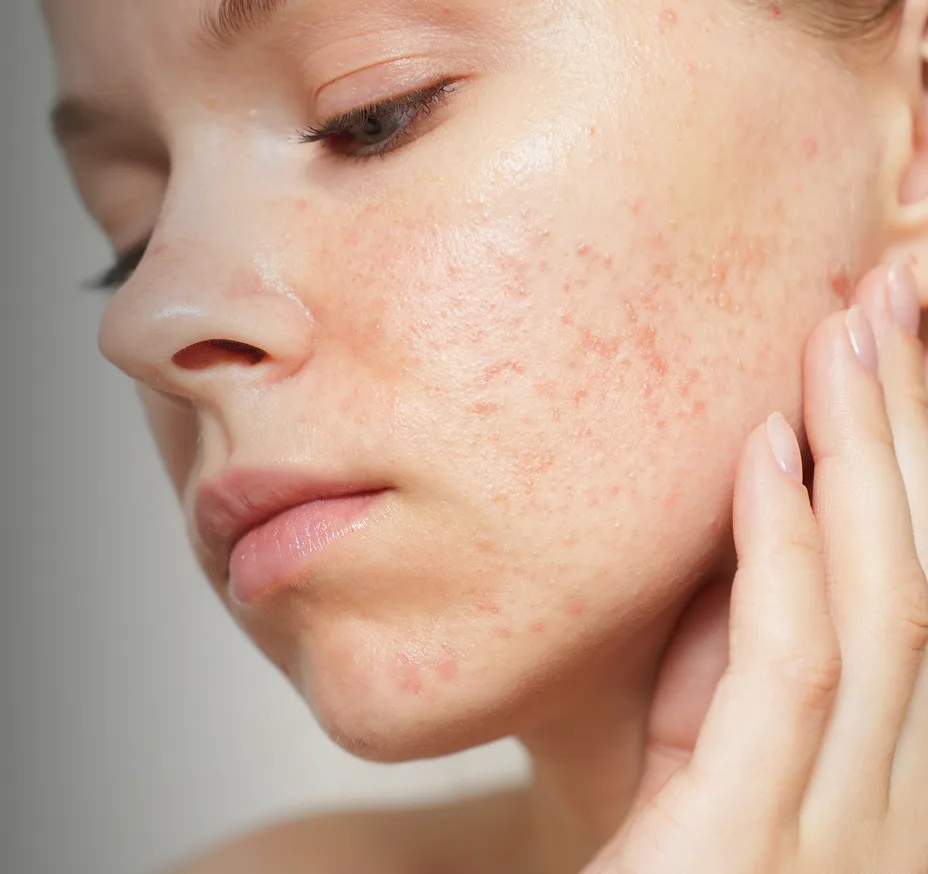 Close-up of person's face with acne breakouts on cheek and jawline