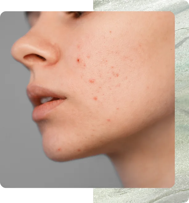 Effective Acne Treatment in Boston, MA Banner