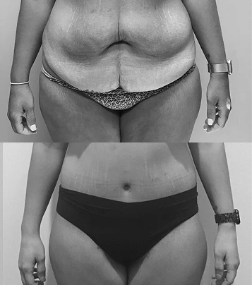 Before and after body contouring results showing reduced abdominal fullness and improved waistline definition