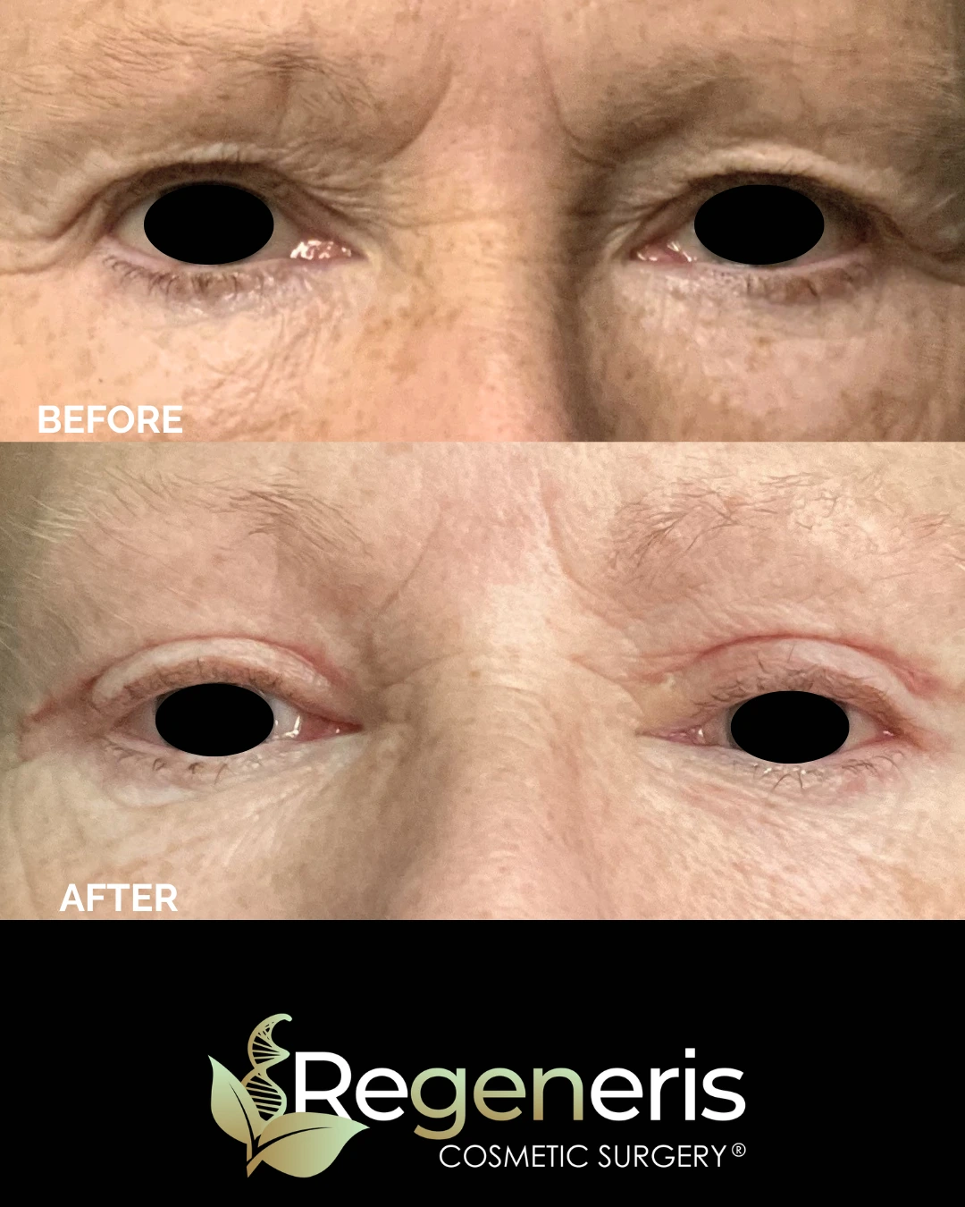 Before and after eyelid surgery comparison showing reduced upper eyelid drooping and puffiness
