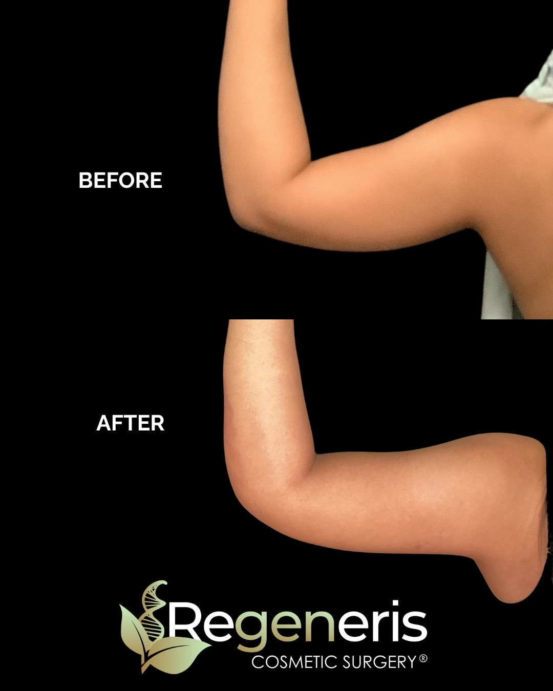 Before and after upper arm showing reduced loose skin and improved definition following VASER treatment, Regeneris Cosmetic Surgery logo