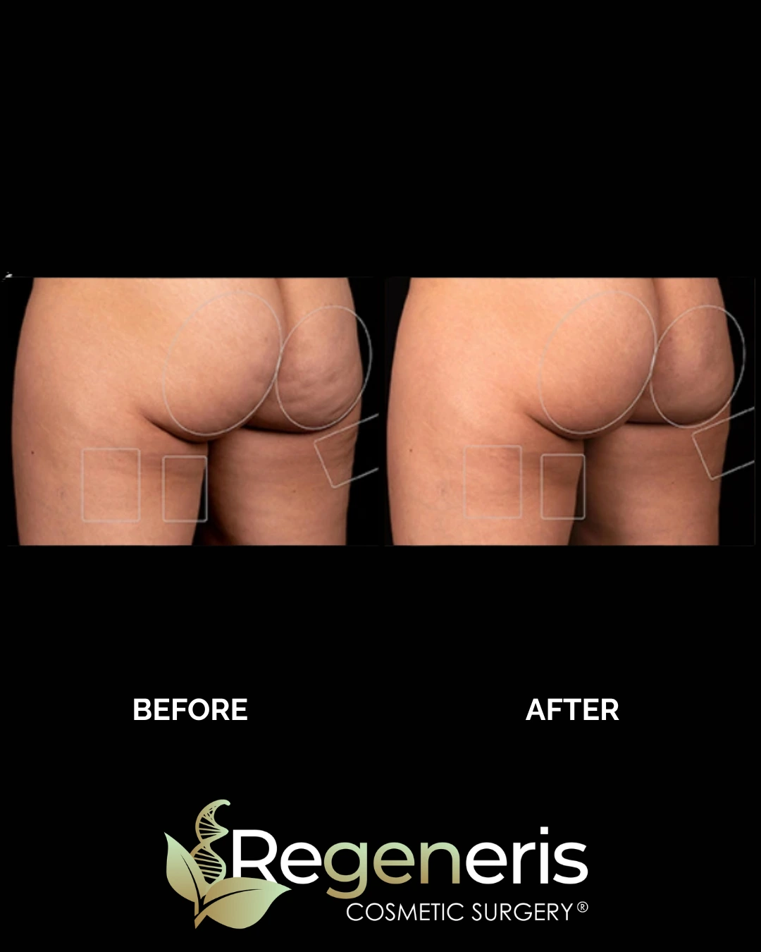 Before and after Aveli cellulite treatment on buttocks and thighs with circled treatment areas