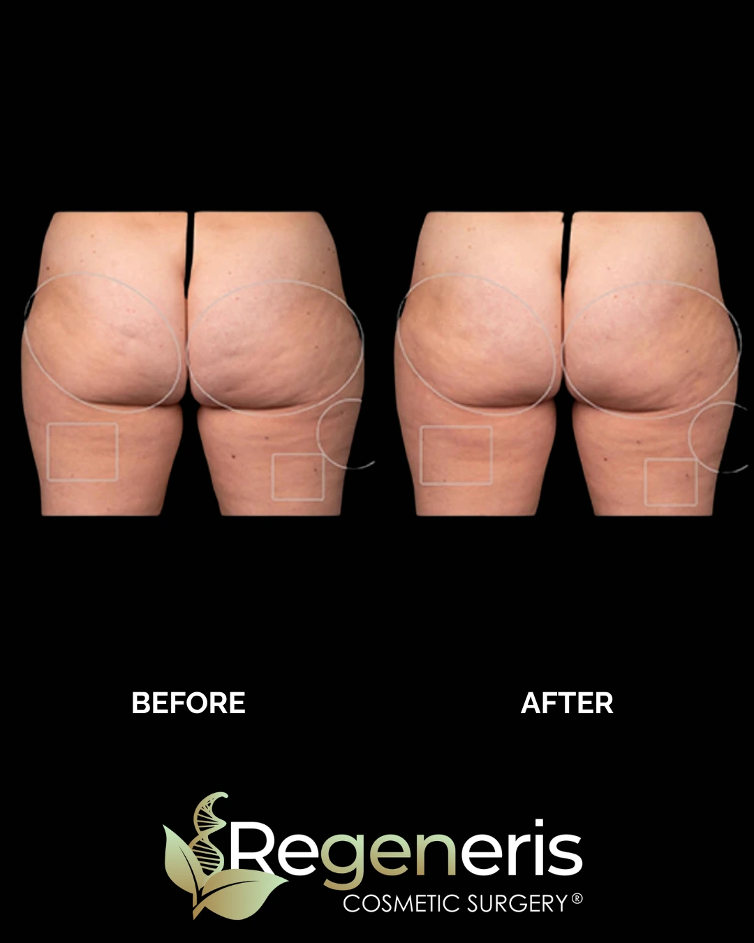 Before and after Aveli cellulite treatment on buttocks and thighs displaying reduced cellulite appearance