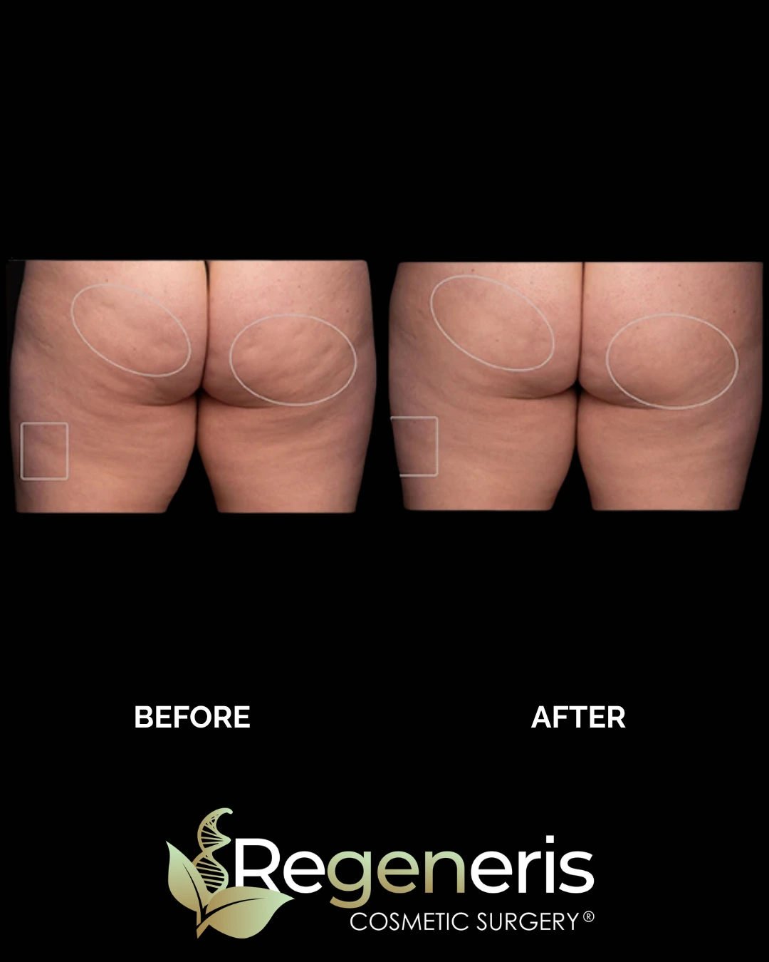 Before and after Aveli cellulite treatment on buttocks and thighs showing reduced dimpling