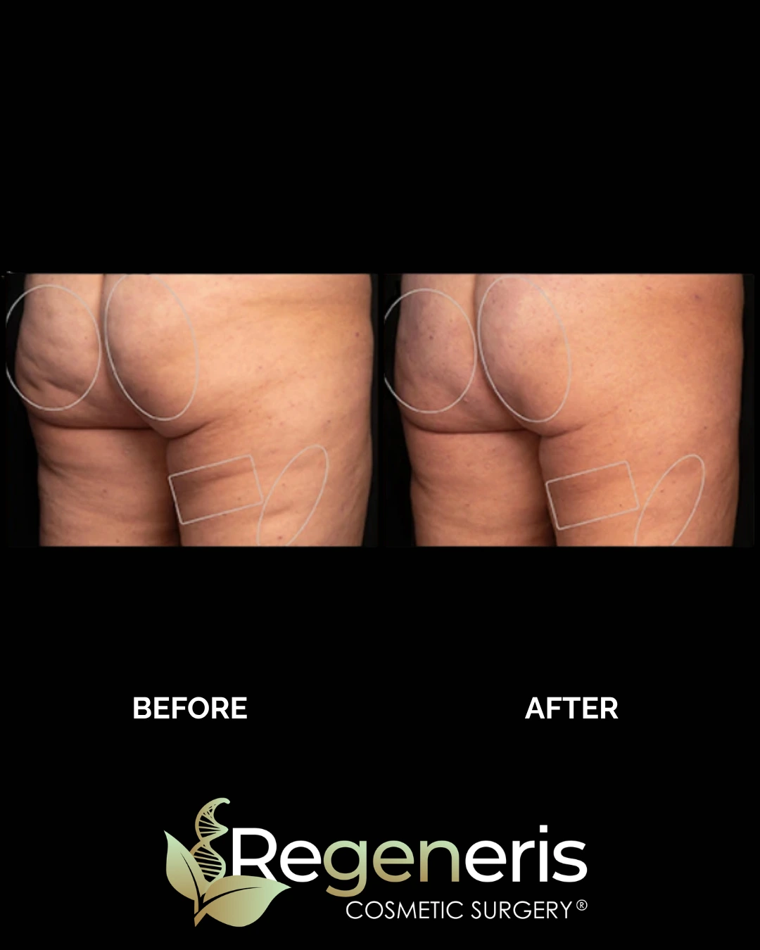Before and after Aveli cellulite treatment on buttocks and lower back showing smoother skin texture