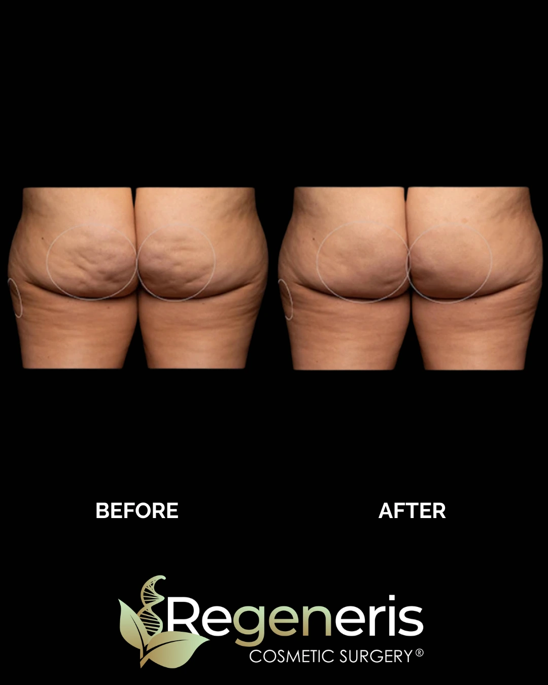 Before and after Aveli cellulite treatment on buttocks and thighs showing improved skin appearance