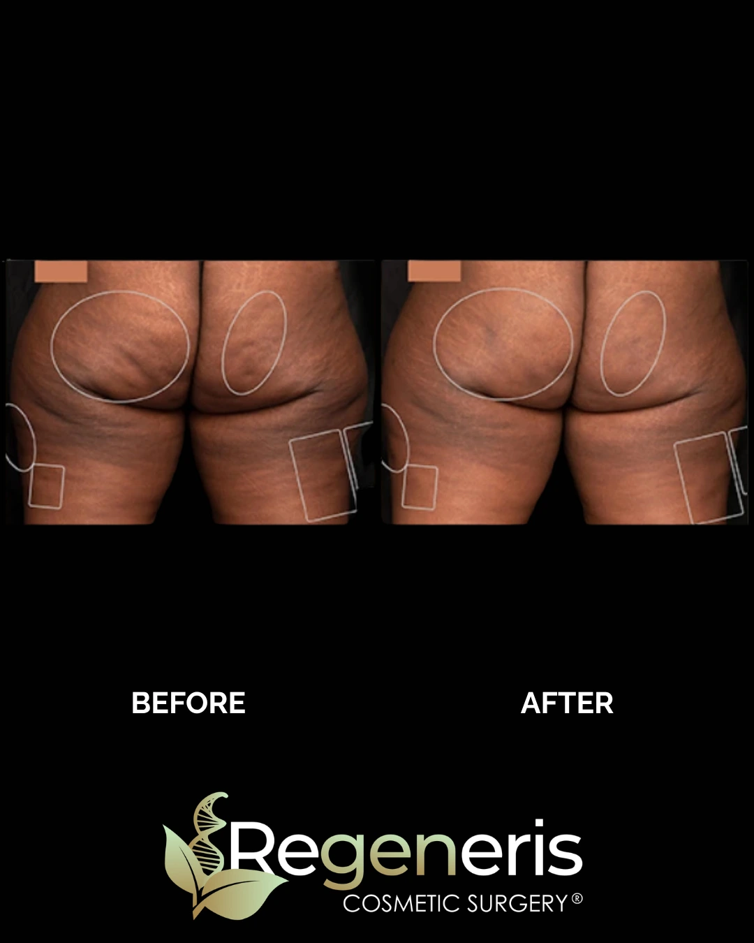 Before and after Aveli cellulite treatment on buttocks, hips and thighs with reduced surface dimpling
