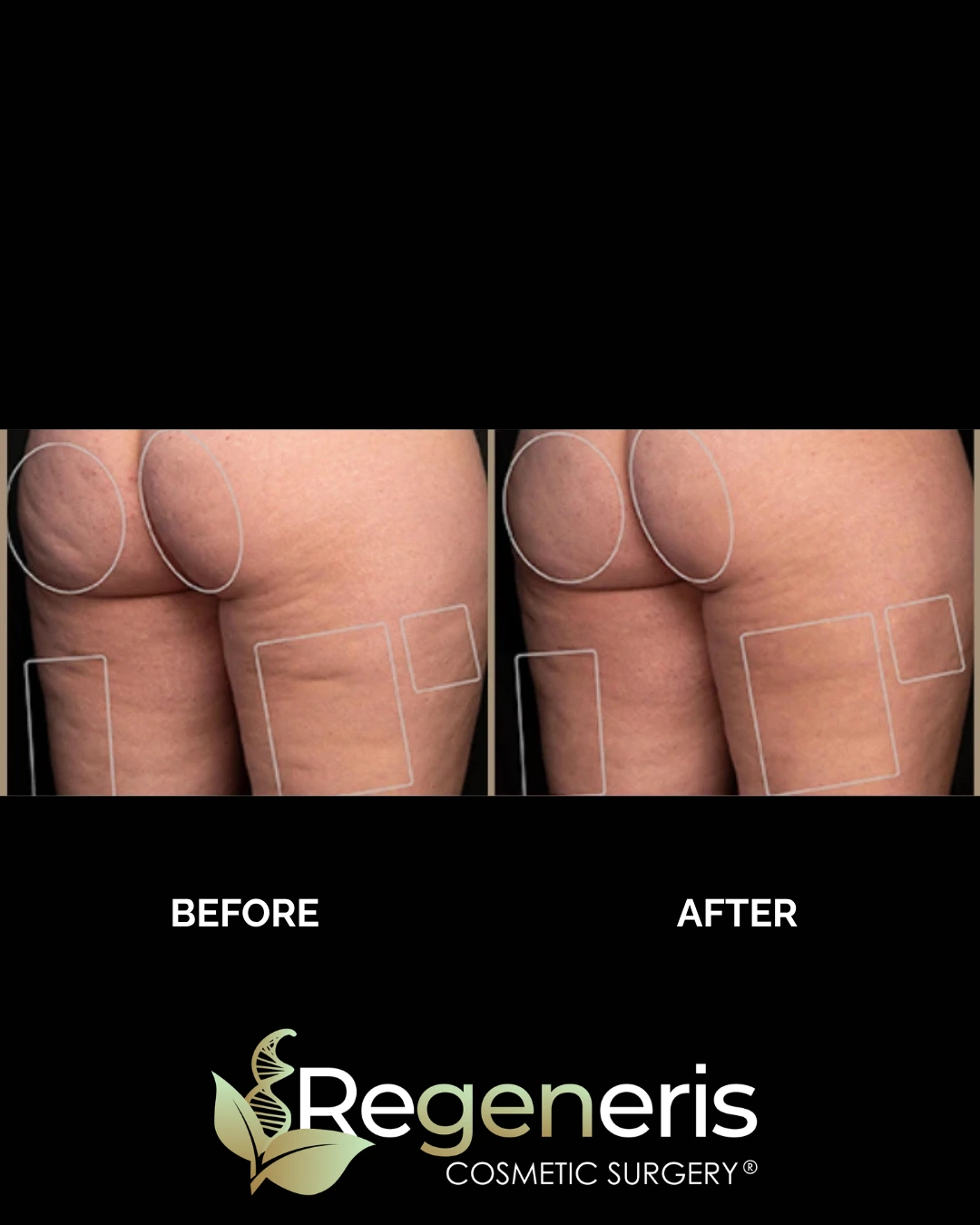 Before and after Aveli cellulite treatment on buttocks and thighs showing smoother contours