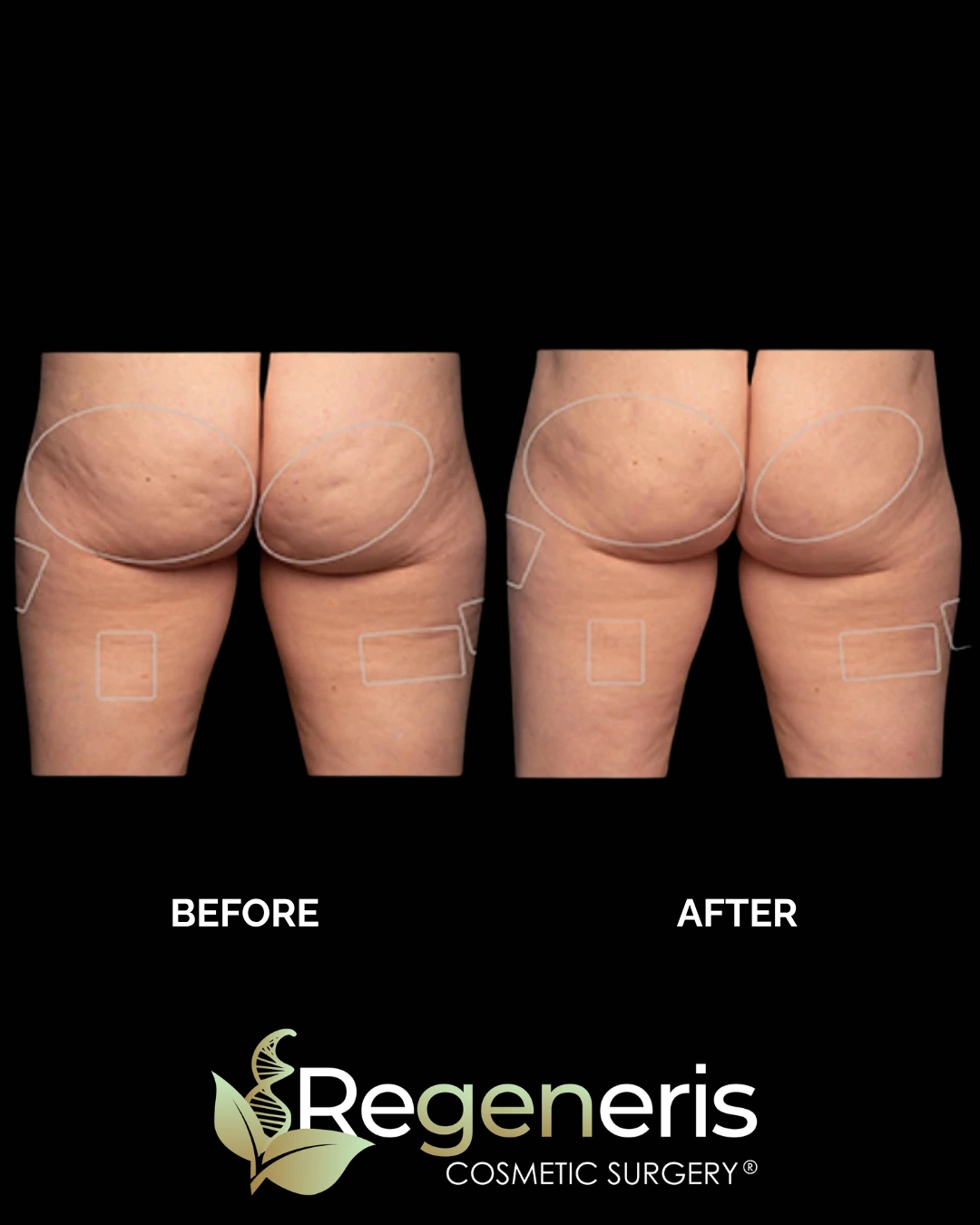 Before and after Aveli cellulite treatment on buttocks and thighs showing reduced dimpling