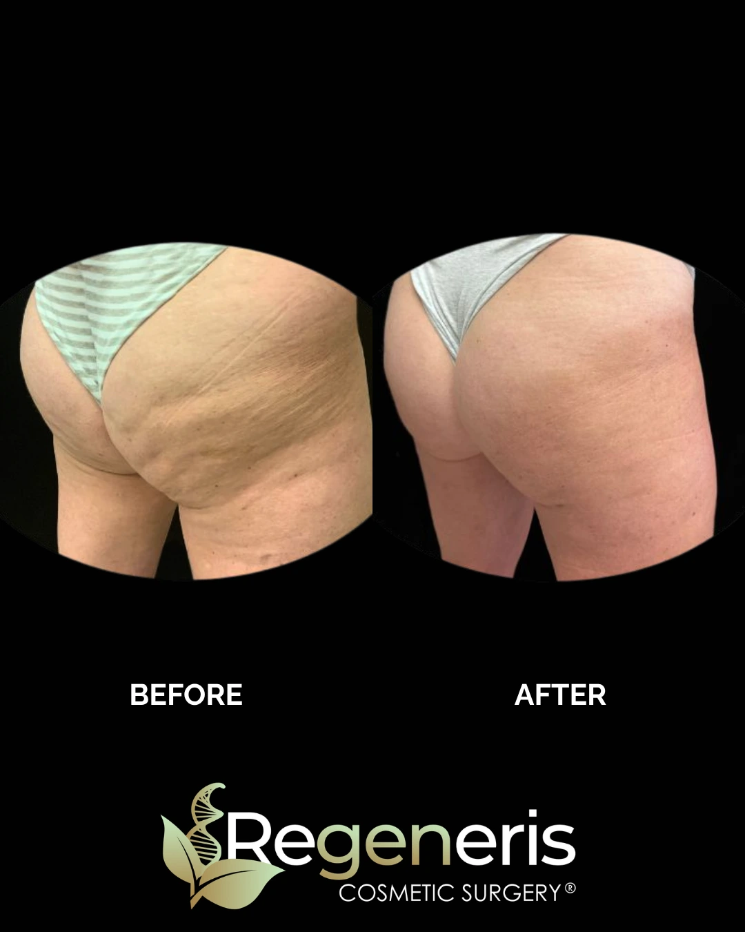 Before and after buttock augmentation showing improved shape and reduced cellulite appearance