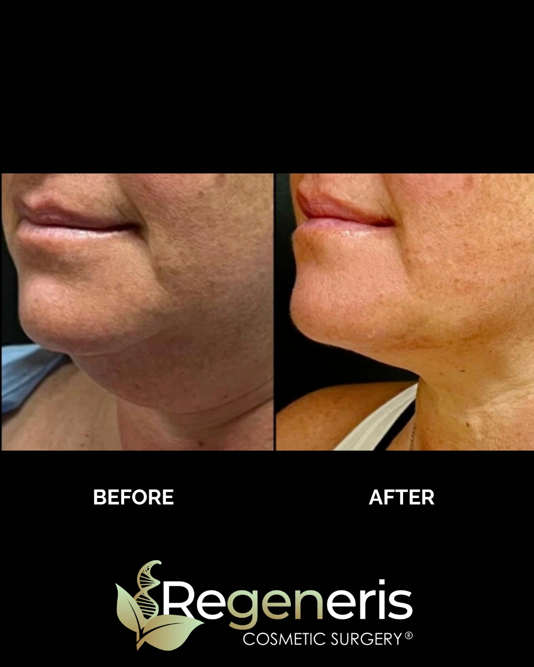 Before and after chin liposuction showing side profile with reduced submental fullness and improved jawline
