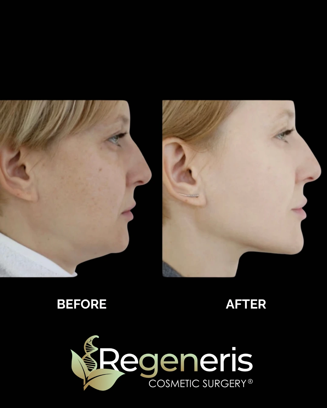 Before and after chin liposuction showing side profile with decreased under-chin fullness and refined neck contour